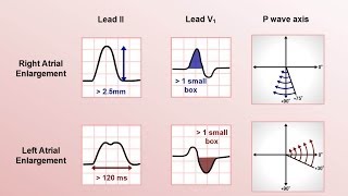 Intro to EKG Interpretation  Chamber Enlargement [upl. by Karena]