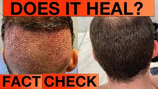 HAIR TRANSPLANT DONOR AREA MONTH 5 DOES IT HEAL [upl. by Gilus]