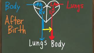 Patent Ductus Arteriosus PDA [upl. by Krueger82]