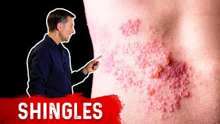 Shingles Natural Relief [upl. by Johnson]