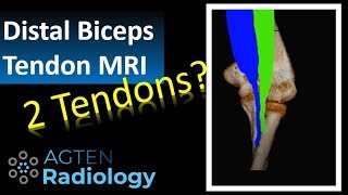 Distal Biceps Tendon Ruptur on MRI [upl. by Emmer]