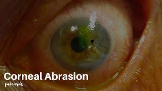 Healing Corneal Abrasions  Dr Alan Mendelsohn [upl. by Allissa]