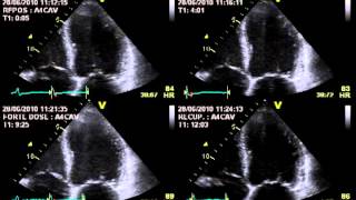 TRUE SEVERE AORTIC STENOSIS  STRESS ECHOCARDIOGRAPHY cardiac ultrasound [upl. by Drahsar220]