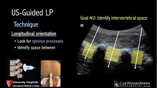 UltrasoundGuided Lumbar Puncture [upl. by Stoll590]