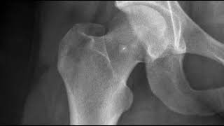 Tear of the posterior hip labrum [upl. by Olathe973]