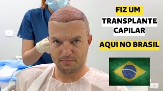 TUDO SOBRE MEU TRANSPLANTE CAPILAR [upl. by Sprung116]