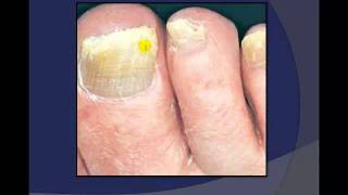 Toenail Debridement by a Podiatrist [upl. by Yewed974]