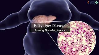 Liver Fibroscan  A smarter alternative to Liver Biopsy l Max Hospital Pitampura [upl. by Hess445]