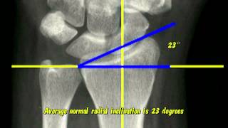 Distal Radius Radiographic Parameters [upl. by Ancilin]