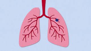 Fibrosis Explained [upl. by Malinda958]