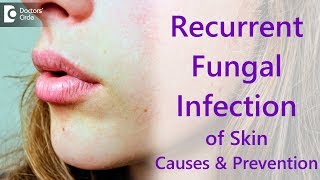 Why do i get recurrent fungal skin infections  Dr Amee Daxini [upl. by Annav950]