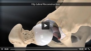 Hip Labral Reconstruction [upl. by Nosdivad]