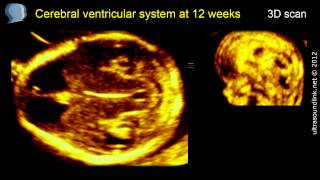 Fetal brain at 12 weeks Cerebral ventricles 3D ultrasound [upl. by Inava]