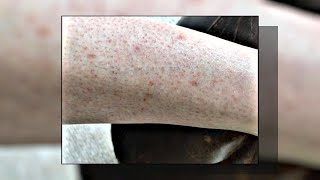 Seborrheic Keratosis What Is It amp How to Treat It [upl. by Sidra]