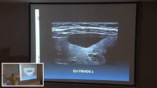 Echographie Thyroidienne Nouvelle Classification Dr JYacoubi [upl. by Nnayt655]