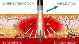 High Intensity Laser  Medical Effects [upl. by Niuqaoj]