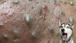 Extreme Blackhead Removal at NaSa Skin Care 10000 [upl. by Deidre61]