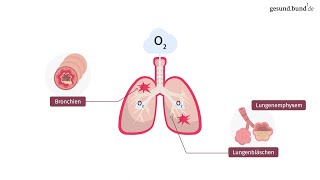 Was ist eine chronisch obstruktive Lungenerkrankung COPD [upl. by Demakis866]