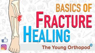 Fracture Healing  ANIMATION  BASICS  The Young Orthopod [upl. by Millhon]