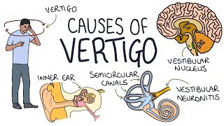 Understanding the Causes of Vertigo [upl. by Rayford]