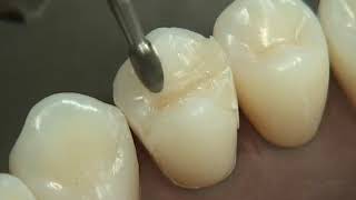 Class II Composite Preparation amp Restoration  Operative Dentistry [upl. by Avram]