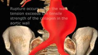 Abdominal Aortic Aneurysm AAA Ultrasound [upl. by Lacey]