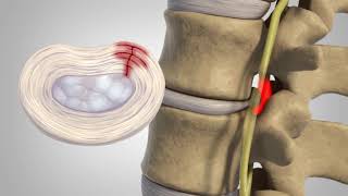 Herniated Disc  Patient Education [upl. by Icyac530]