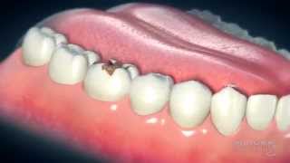 Dental Crowns Everything You Need to Know [upl. by Ninaj311]