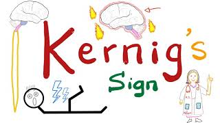 Kernig Sign  Meningitis  Neurology Physical Exam [upl. by Oribelle]