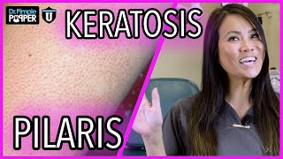 What Are These Bumps On My Skin  Keratosis Pilaris  with Dr Sandra Lee [upl. by Oirretno]