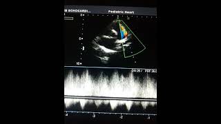 Patent Ductus Arteriosus  Echocardiography [upl. by Winsor]