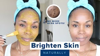 How to Brighten Skin Reduce Acne Scars Hyperpigmentation amp Discoloration  Home Remedies [upl. by Eilahs]