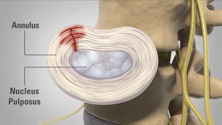 Patient Animation  Lumbar Degenerative Disc Disease [upl. by Annahsed]