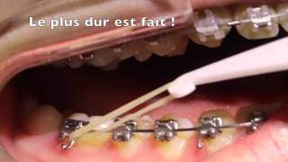 Mettre ses élastiques intermaxillaires en orthodontie [upl. by Maples]