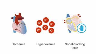 Managing cardiogenic shock [upl. by Balough]