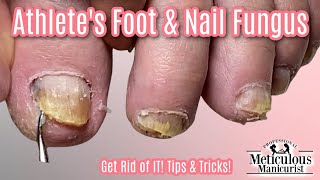 Reverse Nail Fungus Caused by Athletes Feet [upl. by Aytac]