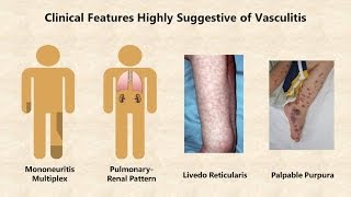 Vasculitis  An Overview [upl. by Hagai]