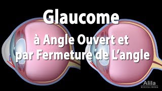 Pathologie du Glaucome Animation [upl. by Onitram]