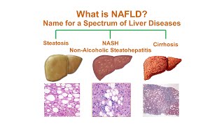 Fatty Liver Disease amp NASH Nonalcoholic Steatohepatitis  Causes Symptoms Diagnosis amp Treatment [upl. by Ferreby]