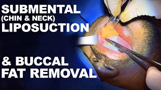 Submental Chin amp Neck Liposuction and Buccal Fat Removal Dr Paul Ruff  West End Plastic Surgery [upl. by Euginomod]