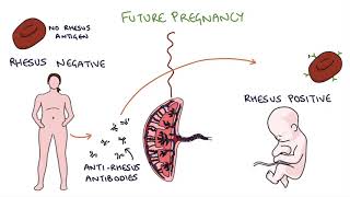 Understanding Rhesus Status and AntiD in Pregnancy [upl. by Norag]