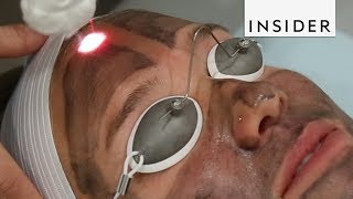 Get Glowing Skin With A Laser Facial [upl. by Tirma]