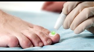 Toenail Fungus Onychomycosis treatment using the FOX Laser [upl. by Obara]