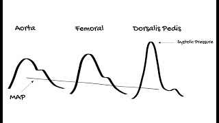 Why does the Intensive Care Unit use Mean Arterial Pressure MAP [upl. by Eusebio]