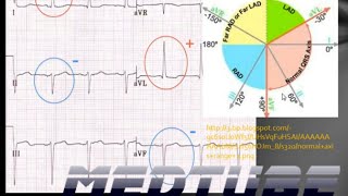 Cardiac Axis Deviations Made Easy [upl. by Aikenat]