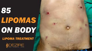 85 Lipomas Removal From Body  Multiple Lipoma Treatment under Local Anesthesia [upl. by Adnilema]