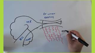 Otovent for glue ear  blocked ear  Eustachian Tube Dysfunction [upl. by Mason]