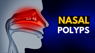 NASAL POLYPS Causes SIgns and Symptoms Diagnosis and Treatment [upl. by Naelcm]