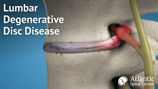 Lumbar Degenerative Disc Disease [upl. by Dolorita]