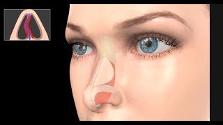 How to Use the Nasal Rinse  LVA2042 [upl. by Odelia]